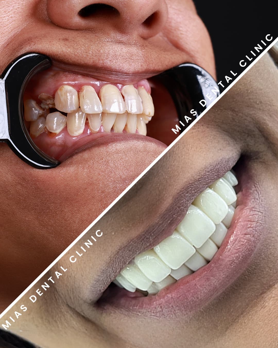 Tam Ağız Restorasyonu Before After