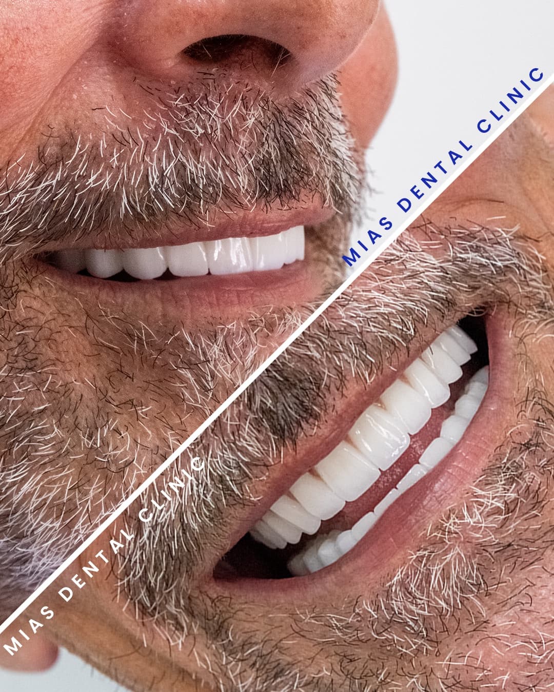 Hollywood Gülüşü Diş Laminaları Sonucu