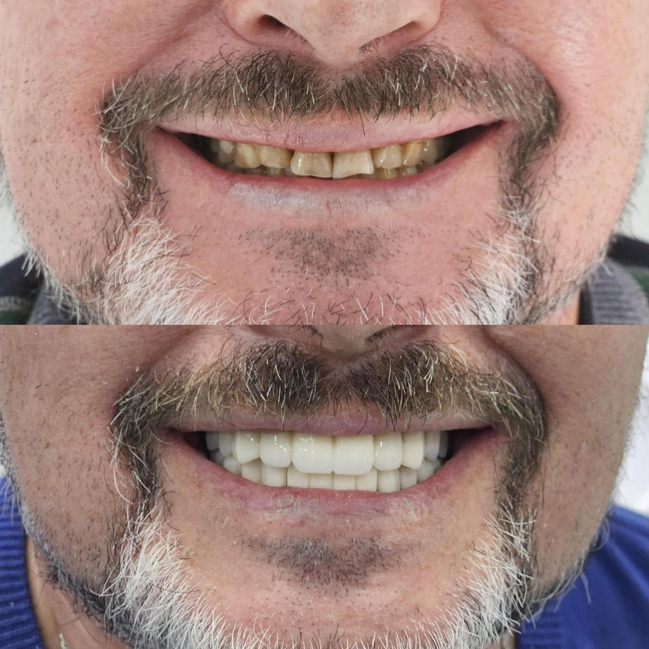 Kadın Gülüş Tasarımı Before After