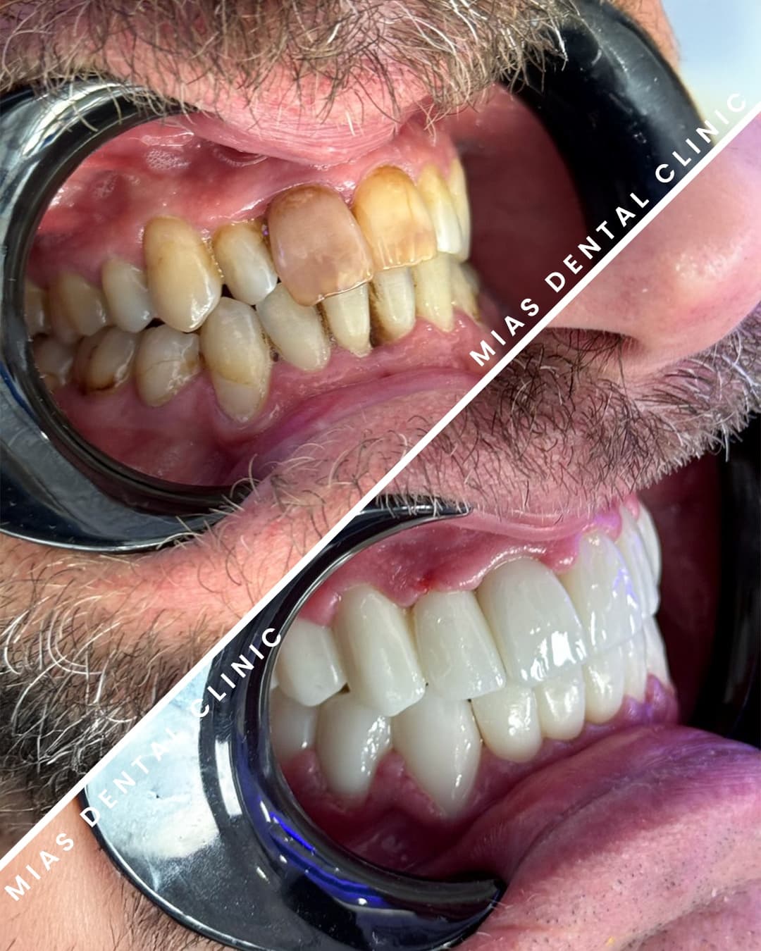 Erkek Gülüş Yenileme Before After